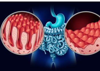 Piles & Fistula